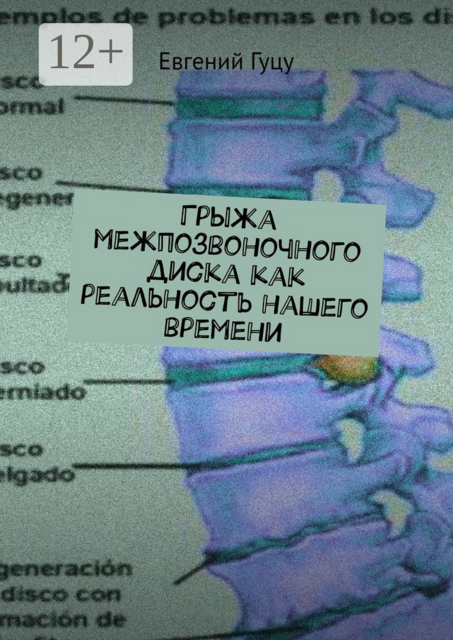 Грыжа межпозвоночного диска как реальность нашего времени, Евгений Гуцу