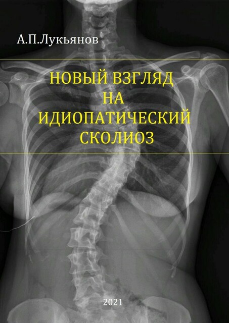 Новый взгляд на идиопатический сколиоз