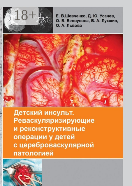 Детский инсульт. Реваскуляризирующие и реконструктивные операции у детей с цереброваскулярной патологией, О.Б. Белоусова, В.А. Лук­шин, Д.Ю. Усачев, Е.В. Шевченко, О.А. Львова